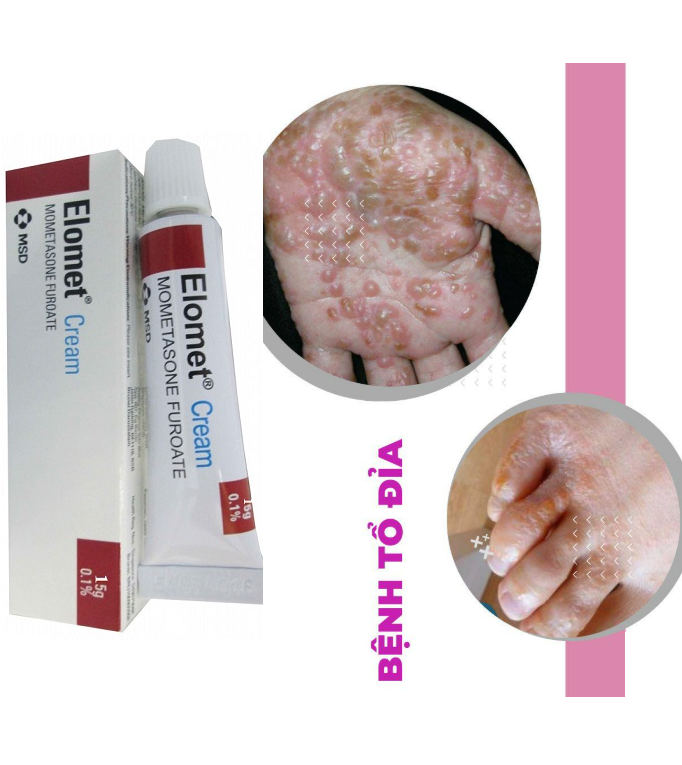 Elomet cream có tác dụng gì? elomet cream đặc trị nấm tổ đỉa