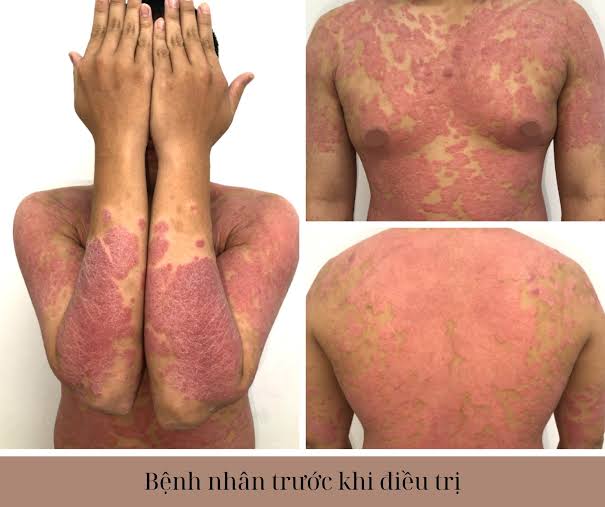 Bệnh vẩy nến: dấu hiệu nhận biết về bệnh, biến chứng nguy hi