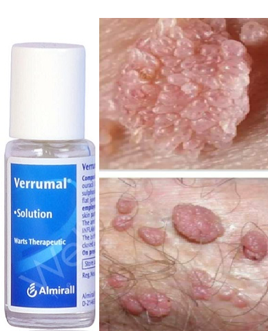 Verrumail có tác dụng gì? verrumal đặc trị sùi mào gà do virus hpv gây ra, thuốc điều trị tại chỗ hiệu quả